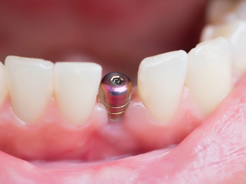 Khả năng ăn nhai như răng thật