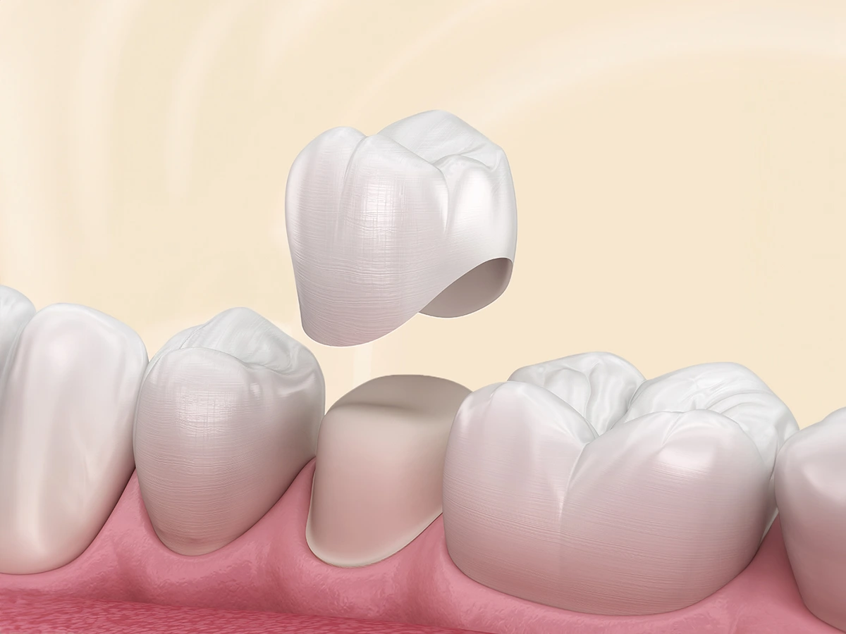 Bọc Răng Sứ Thẩm Mỹ: Giải Pháp Phục Hình Răng Hiện Đại Từ Nha Khoa Dentos