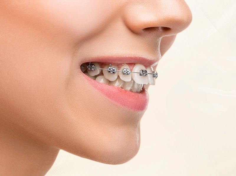 Niềng Răng Mắc Cài Kim Loại (Trẻ Em)