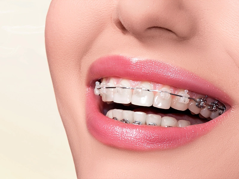 Niềng Răng Mắc Cài Sứ/Pha Lê (Trẻ Em)