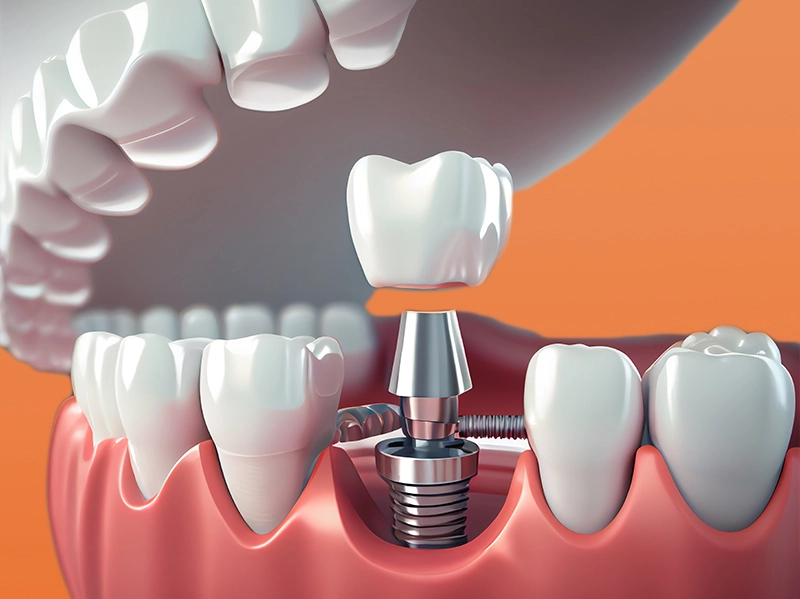 Trồng Răng Implant Đơn Lẻ