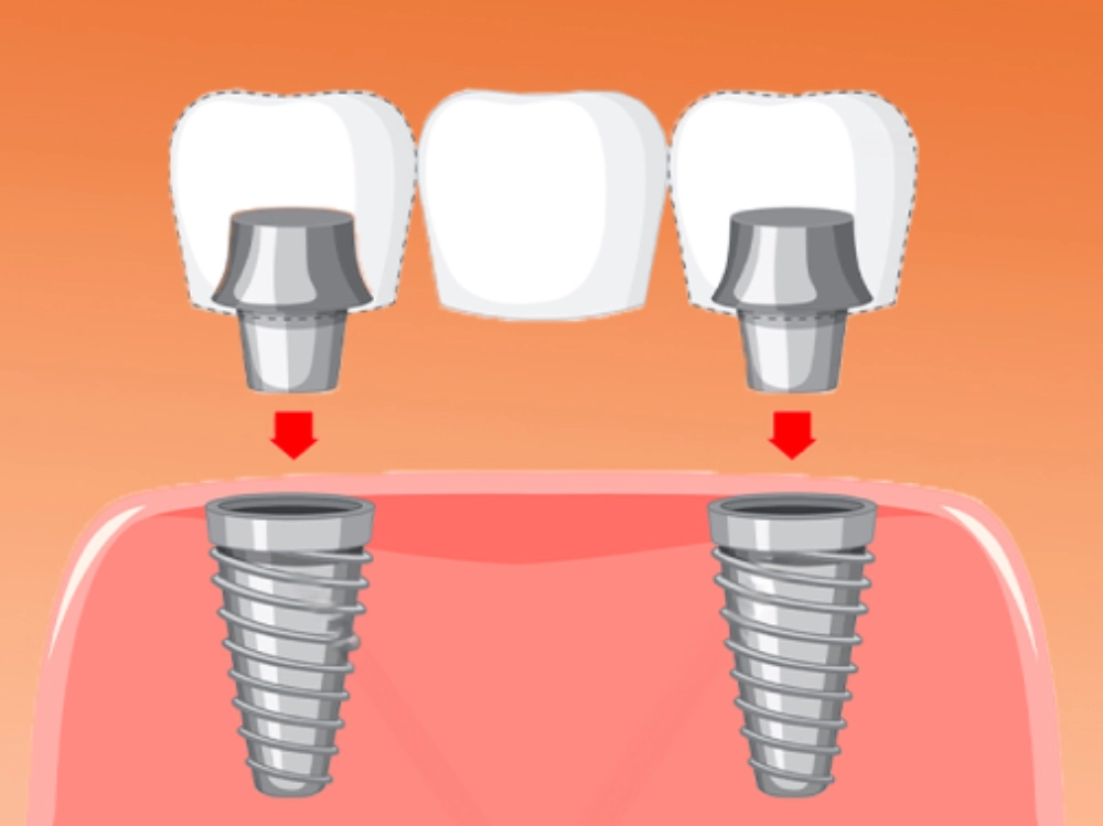 Cầu Răng Implant
