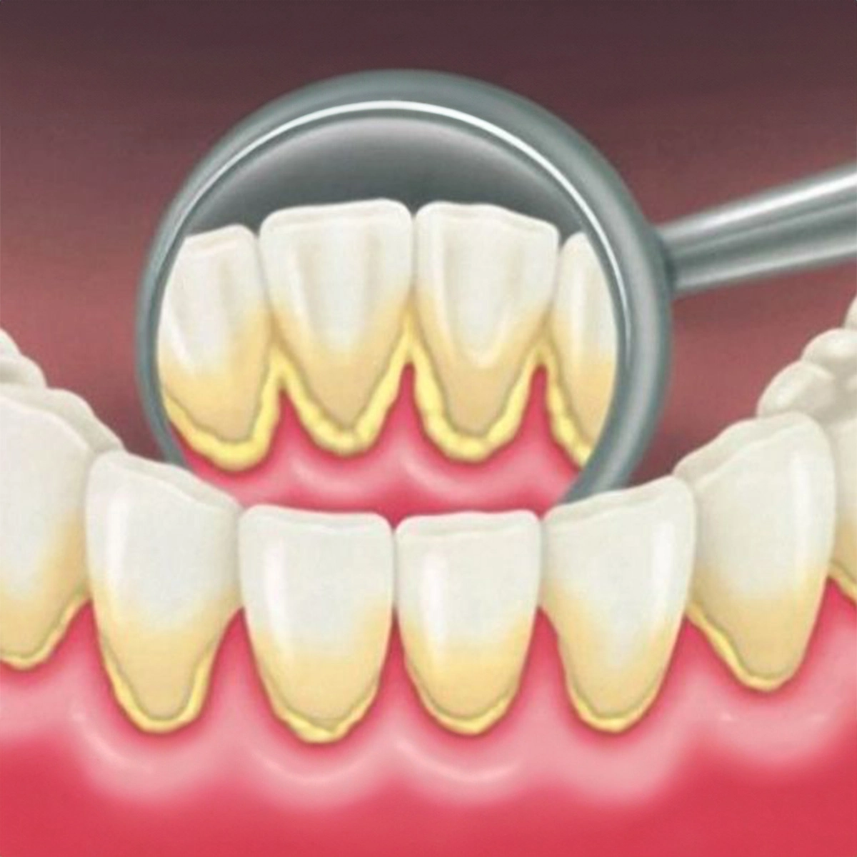 Cao Răng Là Gì? Vì Sao Chải Răng Thông Thường Không Sạch?