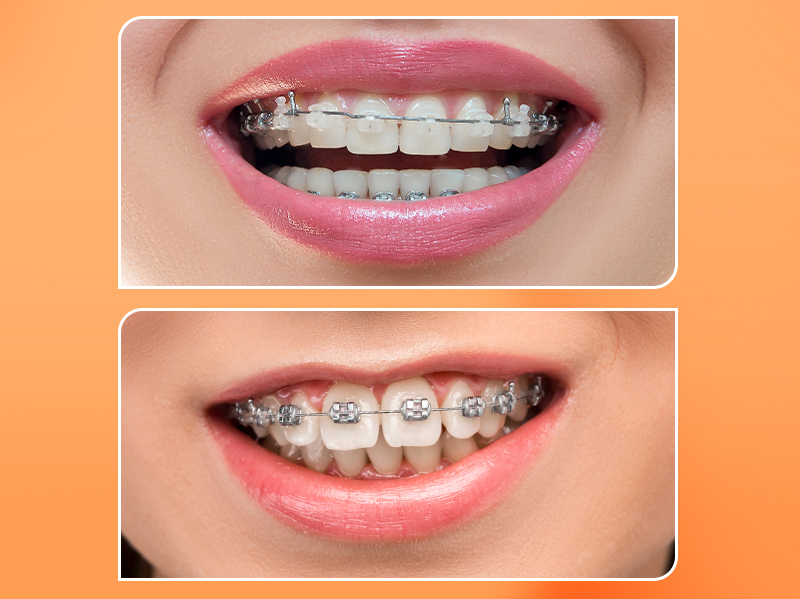 Mắc Cài Sứ vs. Mắc Cài Kim Loại