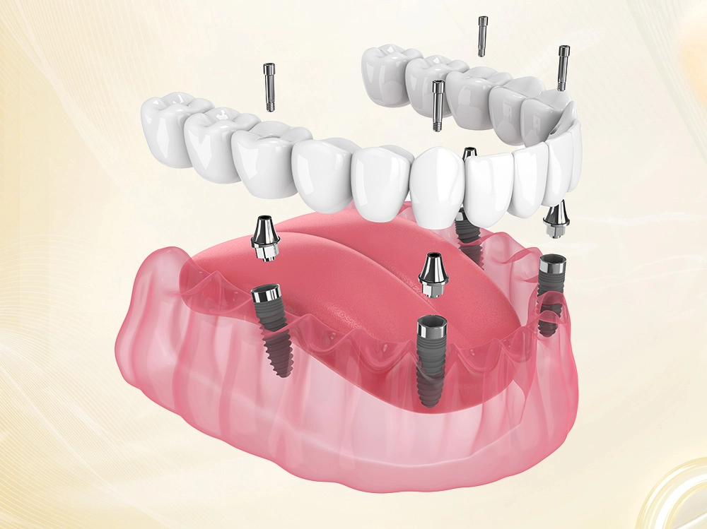 Implant Toàn Hàm All-on-4 / All-on-6