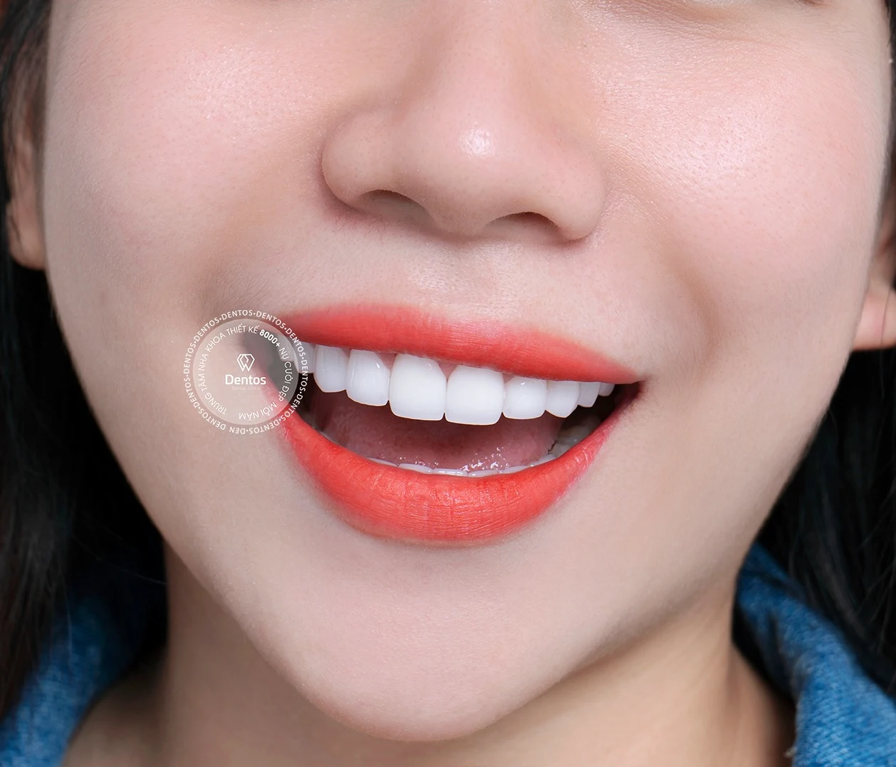 Răng nhiễm màu nên tẩy trắng, dán veneer hay bọc răng sứ?