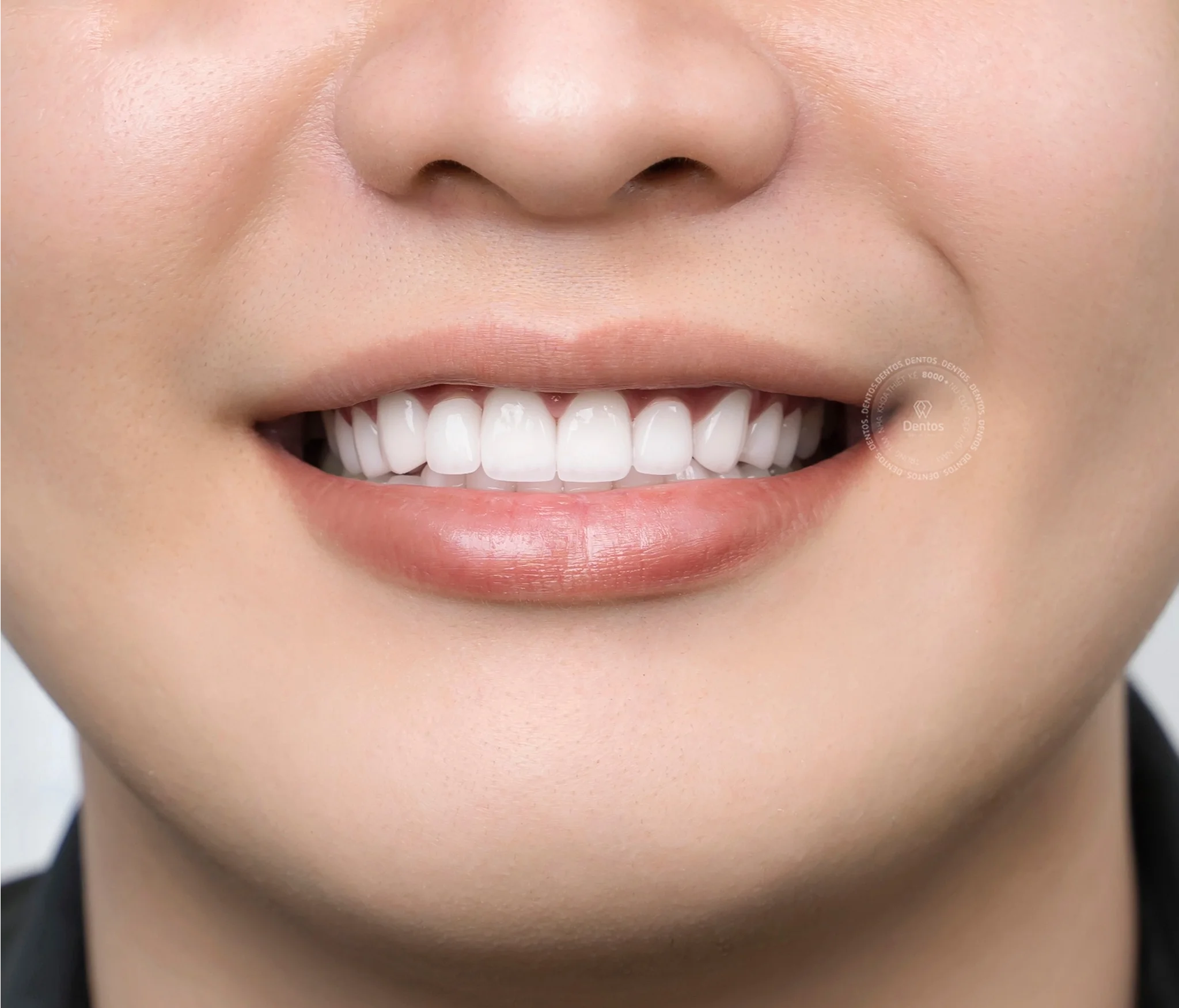 Răng sứ bị hỏng là do đâu? Làm sao để khắc phục?