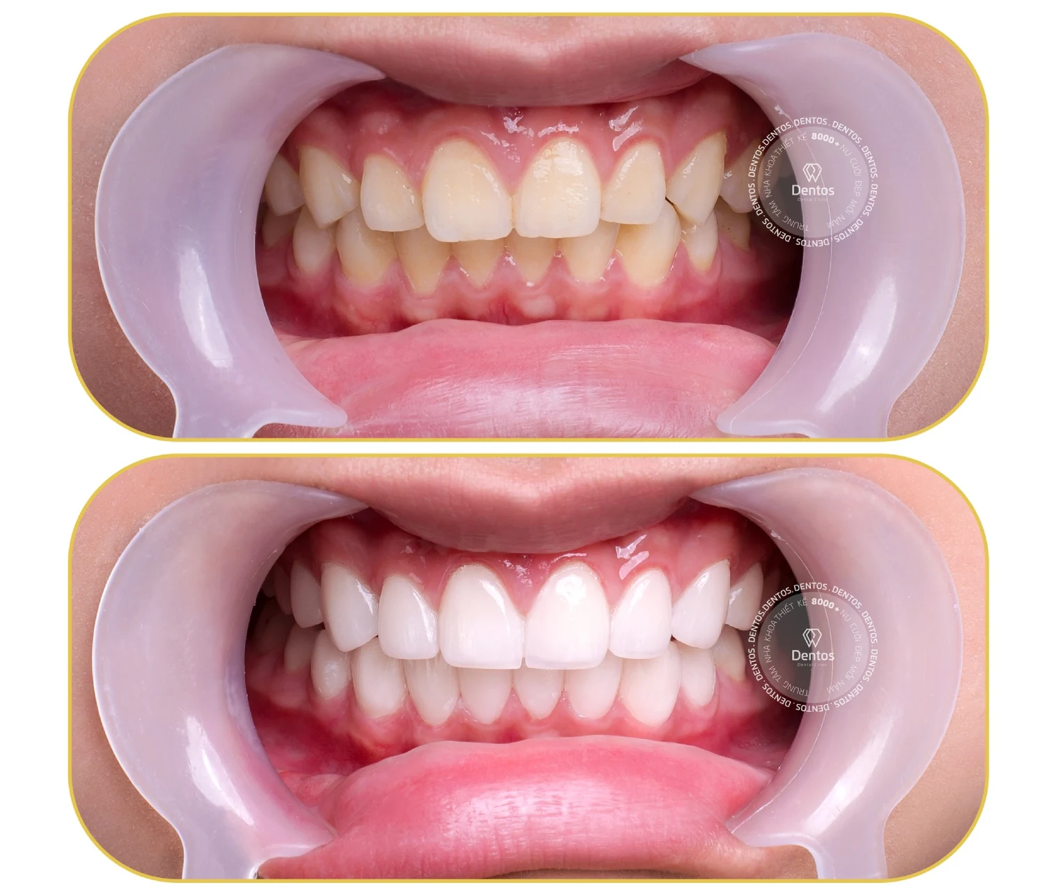 Những sự thật về bọc răng sứ không phải ai cũng biết