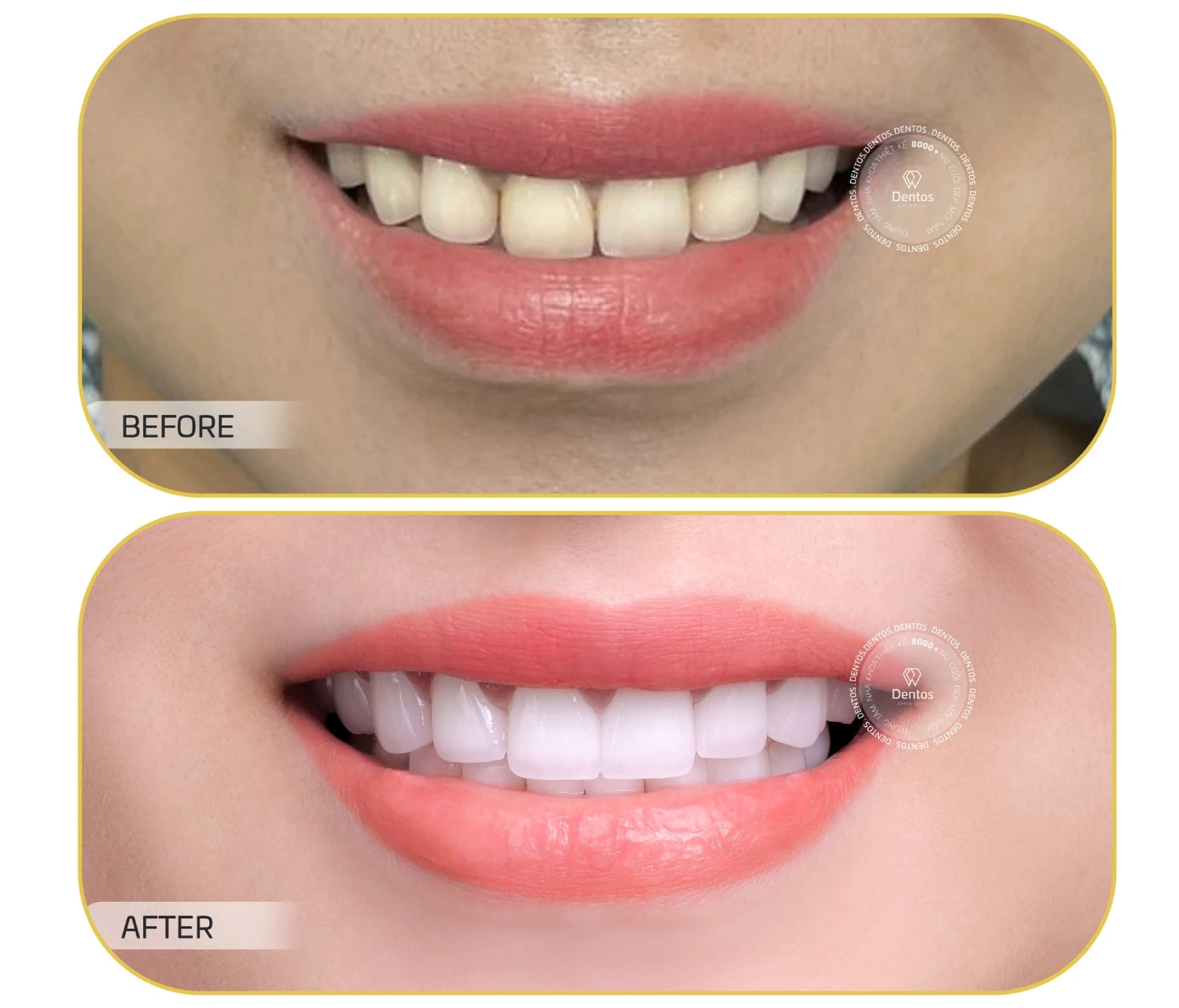 Góc giải đáp: Làm răng sứ có bị hôi miệng không?