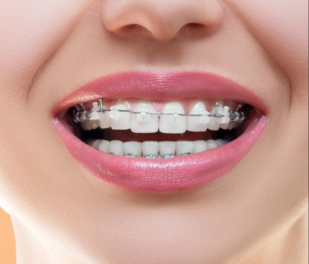 Bọc răng sứ có niềng được không?