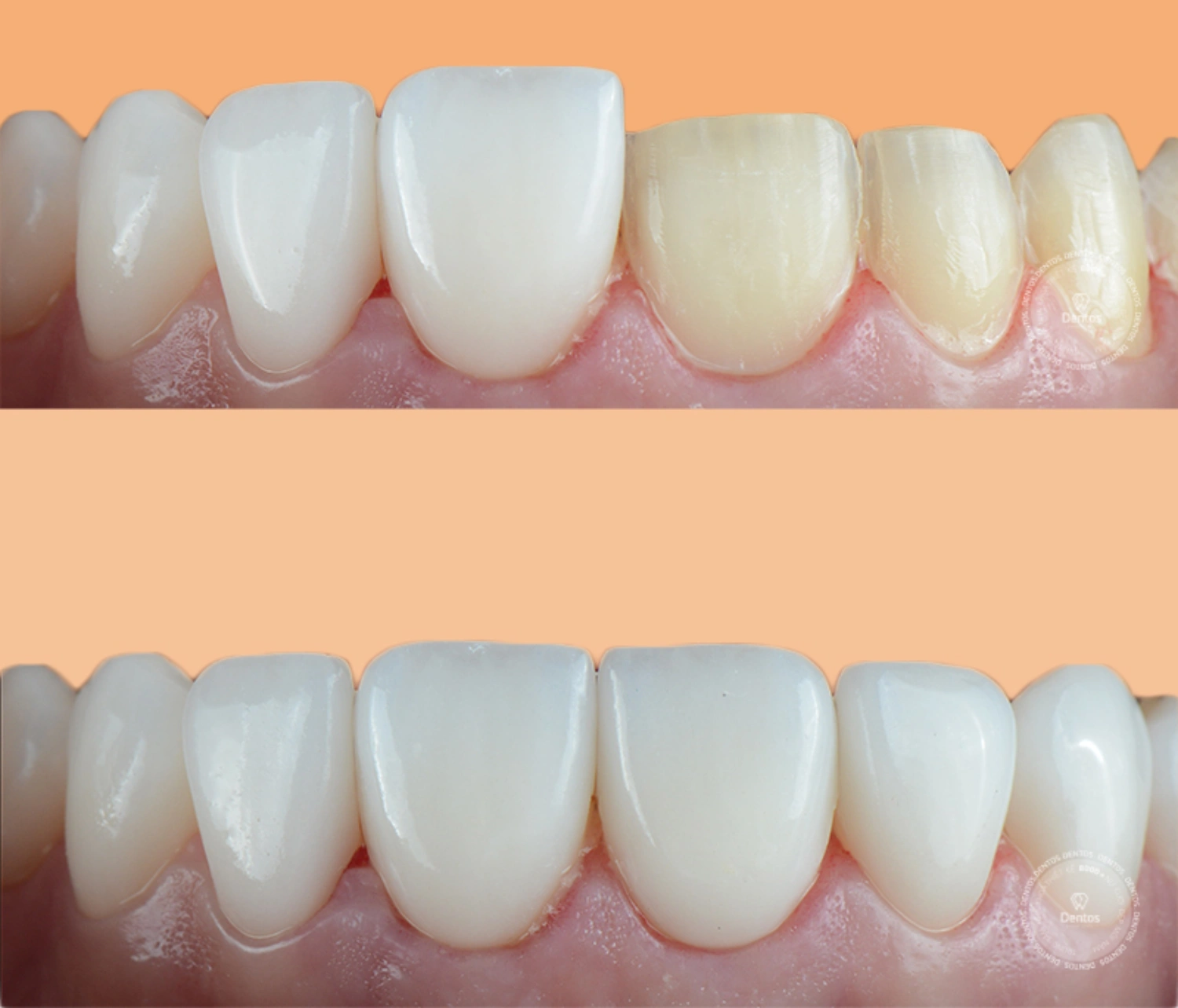 Emax Veneers và những điều bạn nên biết