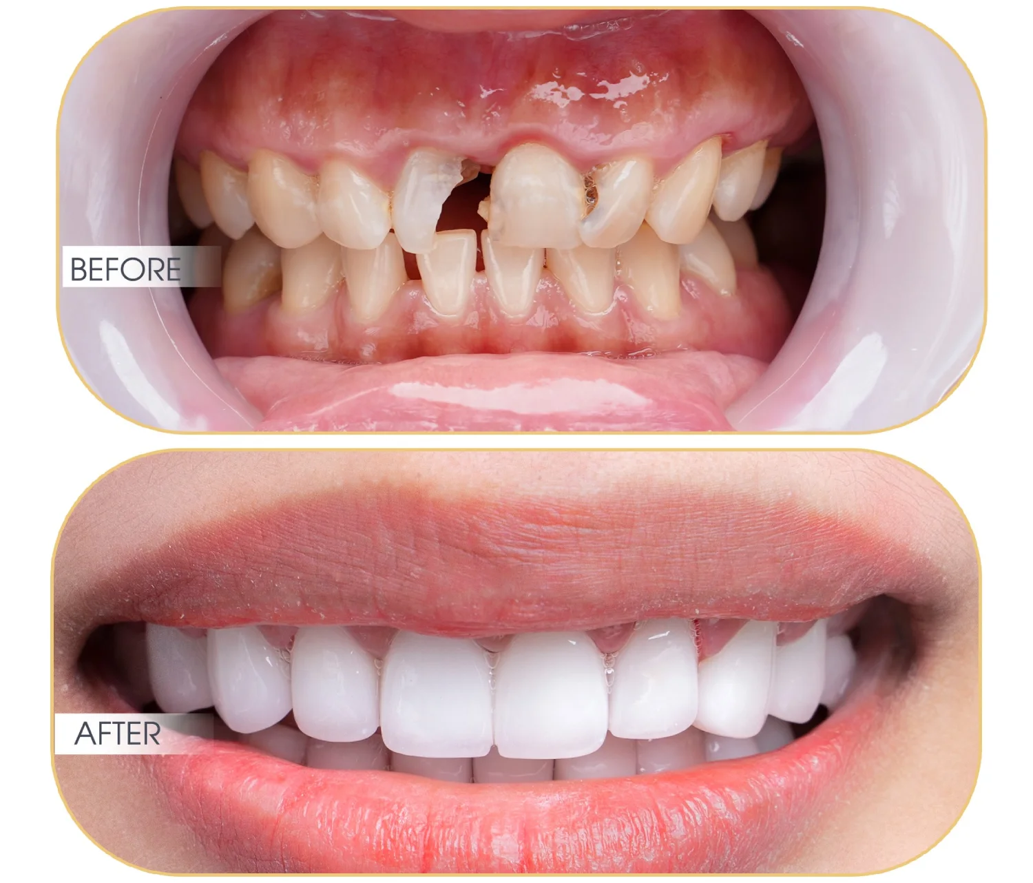 Răng cửa bị mẻ bọc răng sứ được không?