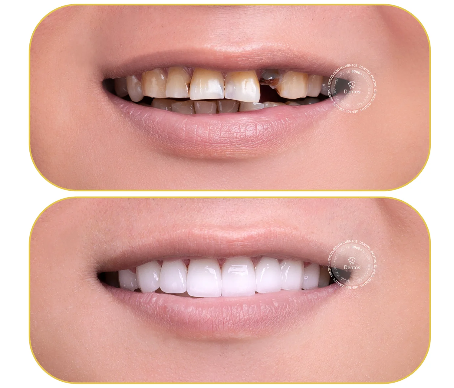 Cảnh báo: Những trường hợp không nên bọc răng sứ bạn cần biết