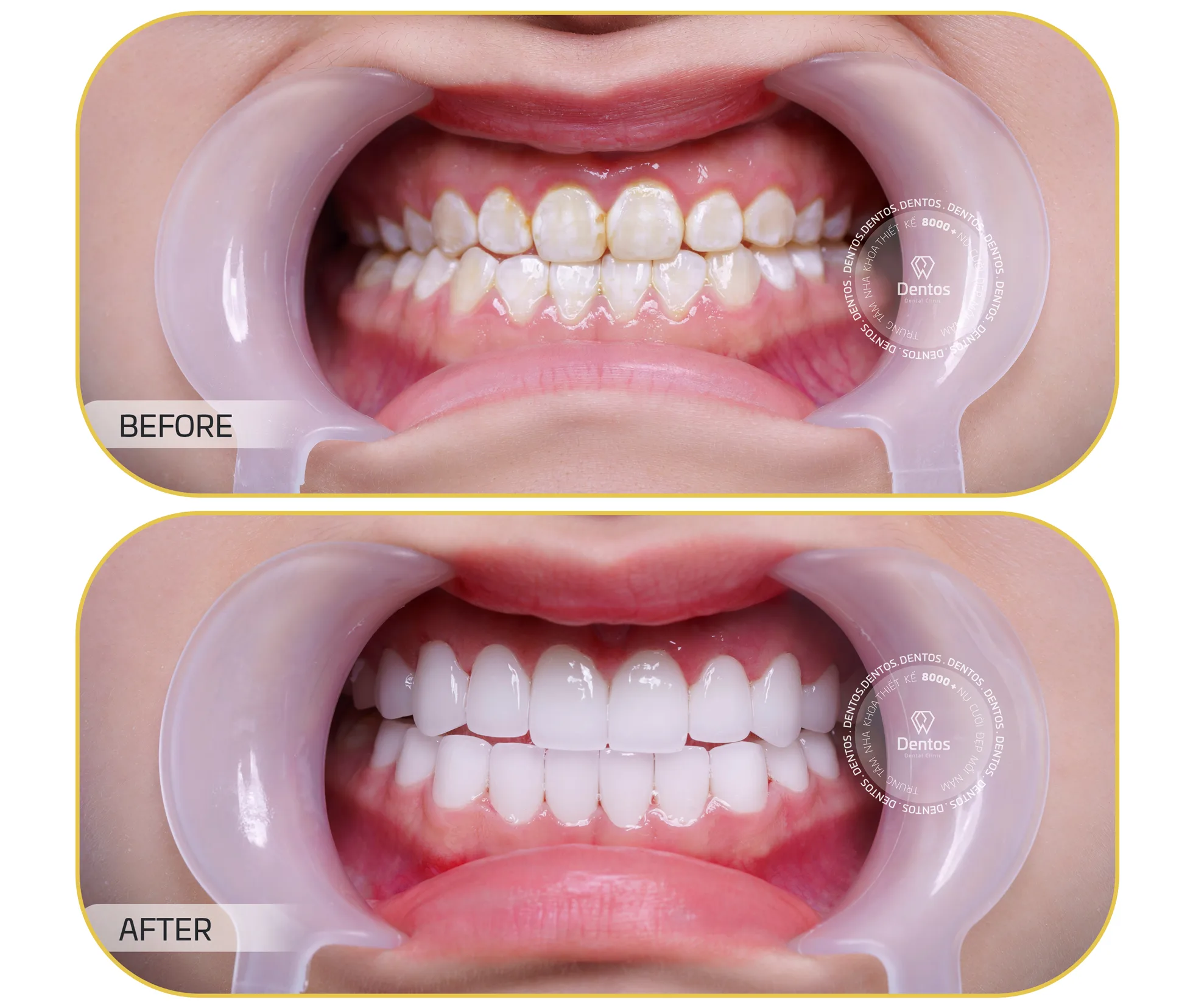 Răng sứ DDBio của nước nào? Có tốt không? Răng sứ DDBio giá bao nhiêu?