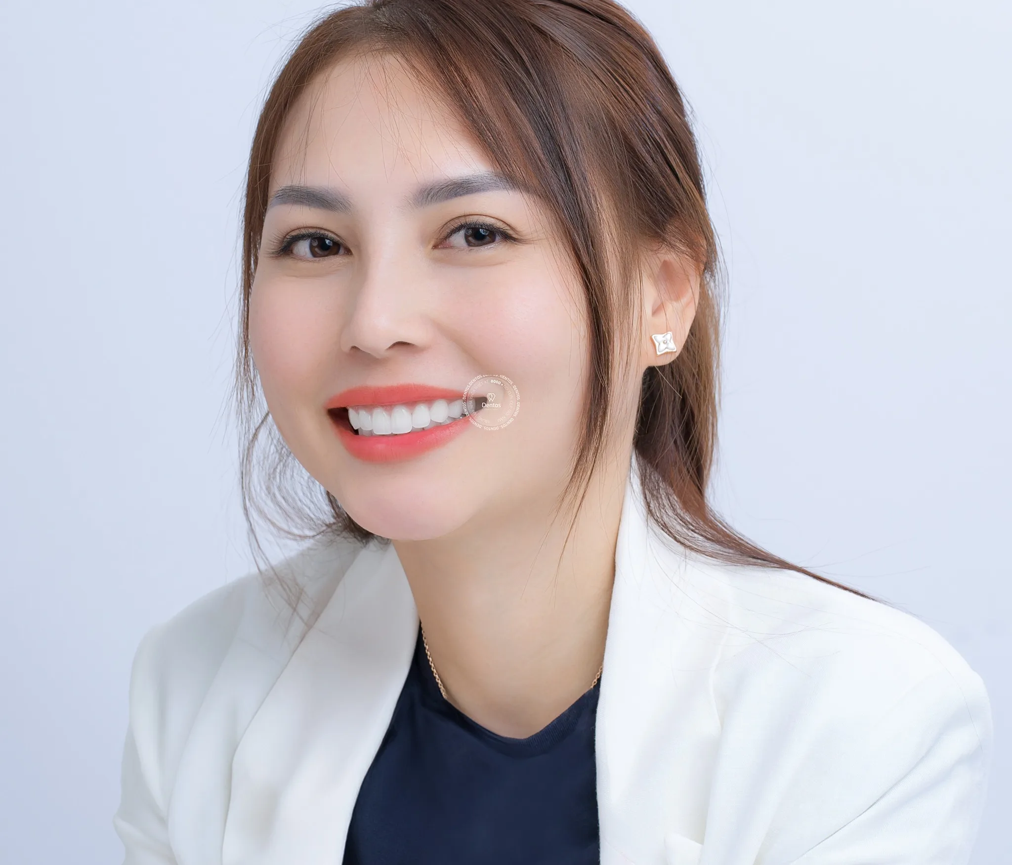 Răng mẻ lớn bọc răng sứ được không?