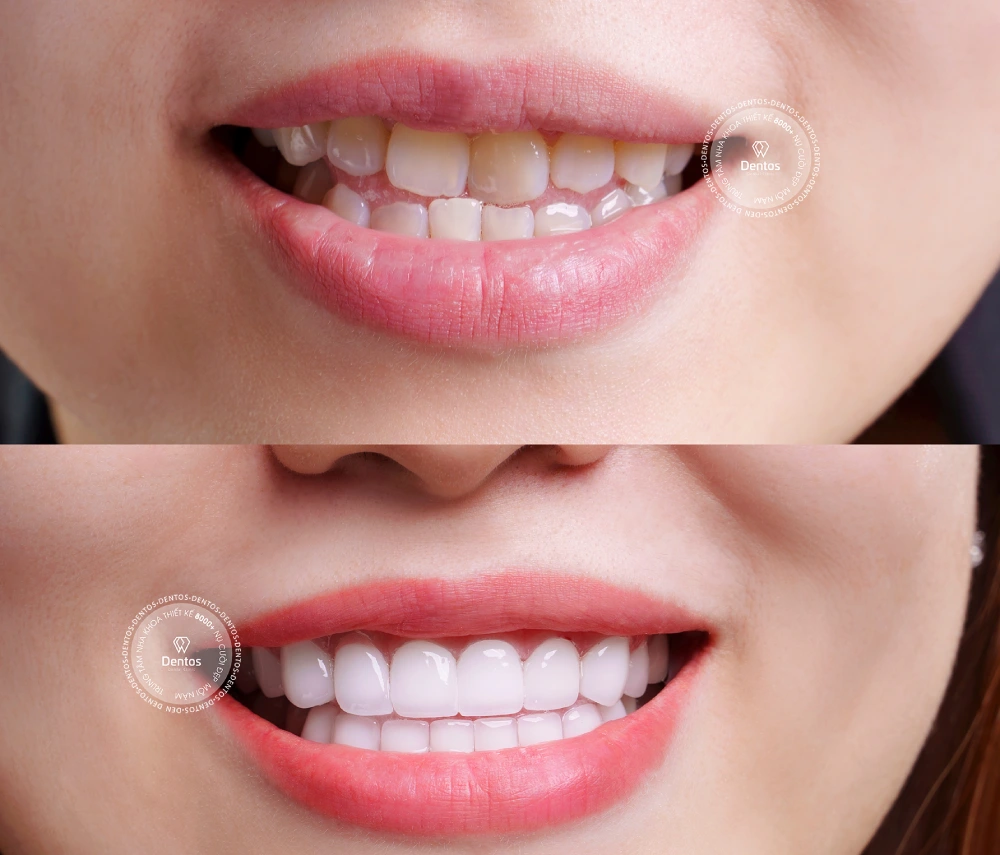Răng sứ bị ố vàng, xỉn màu có tẩy trắng được không?