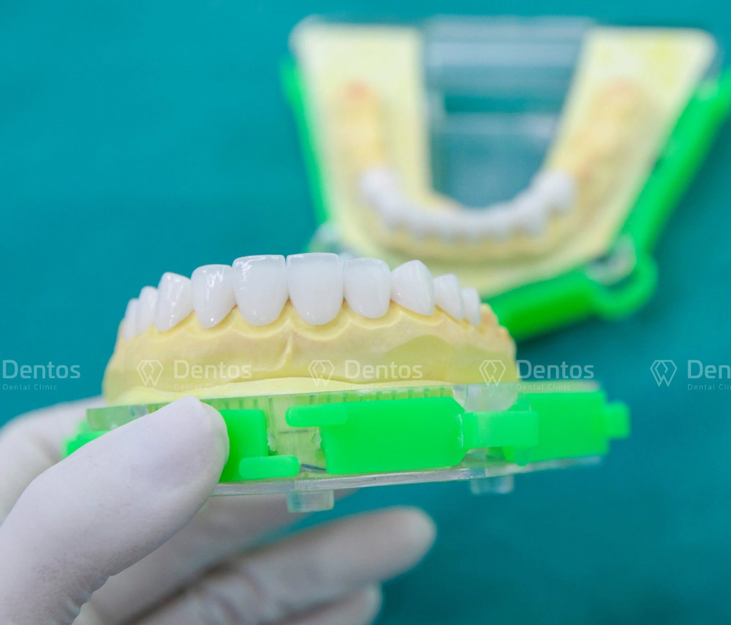 So sánh răng sứ kim loại và răng toàn sứ: Có gì khác nhau? Loại nào tốt hơn?
