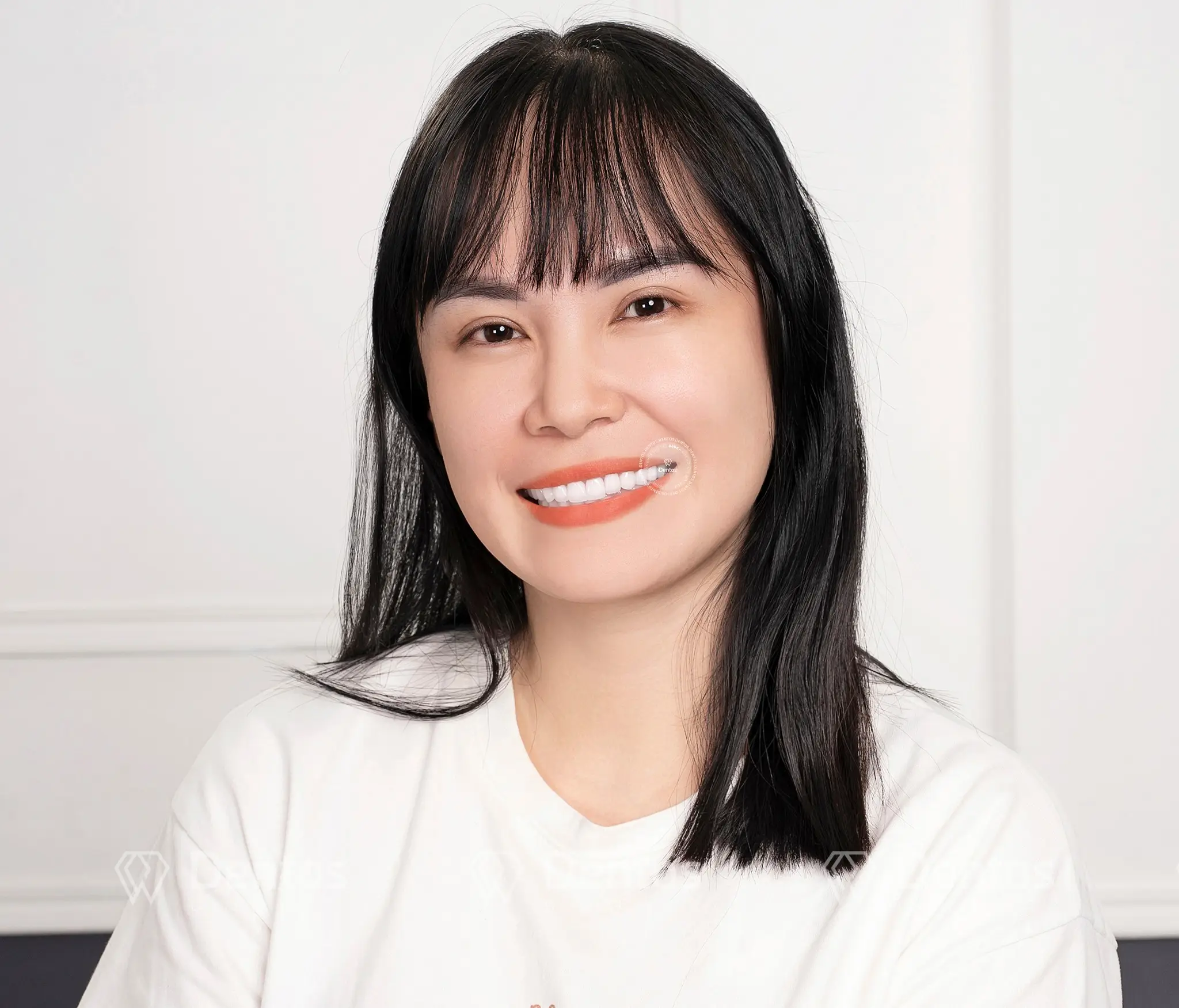 Răng thưa nên niềng hay bọc răng sứ?