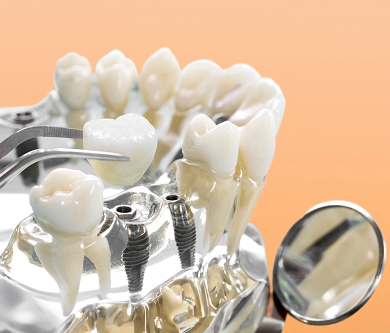 Mất răng nên làm cầu răng sứ hay trồng Implant?