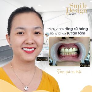 Đổi răng sứ cũ lấy răng sứ mới có hiệu quả không?