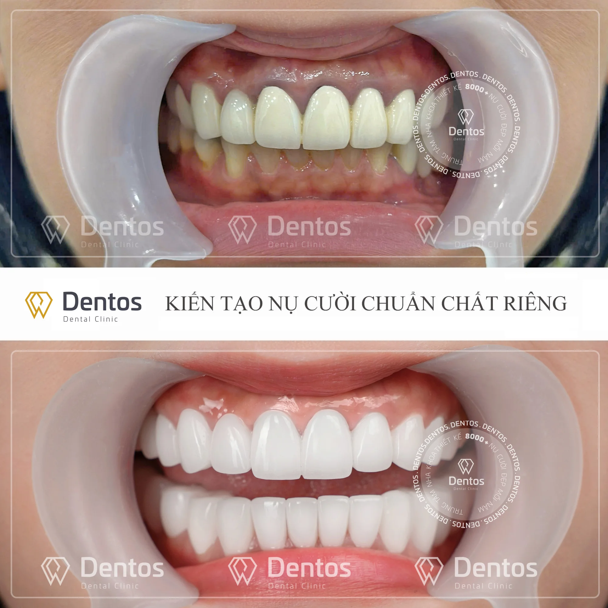 Before/After: Xóa bỏ răng sứ bị đen viền nướu, trả lại nụ cười tự tin