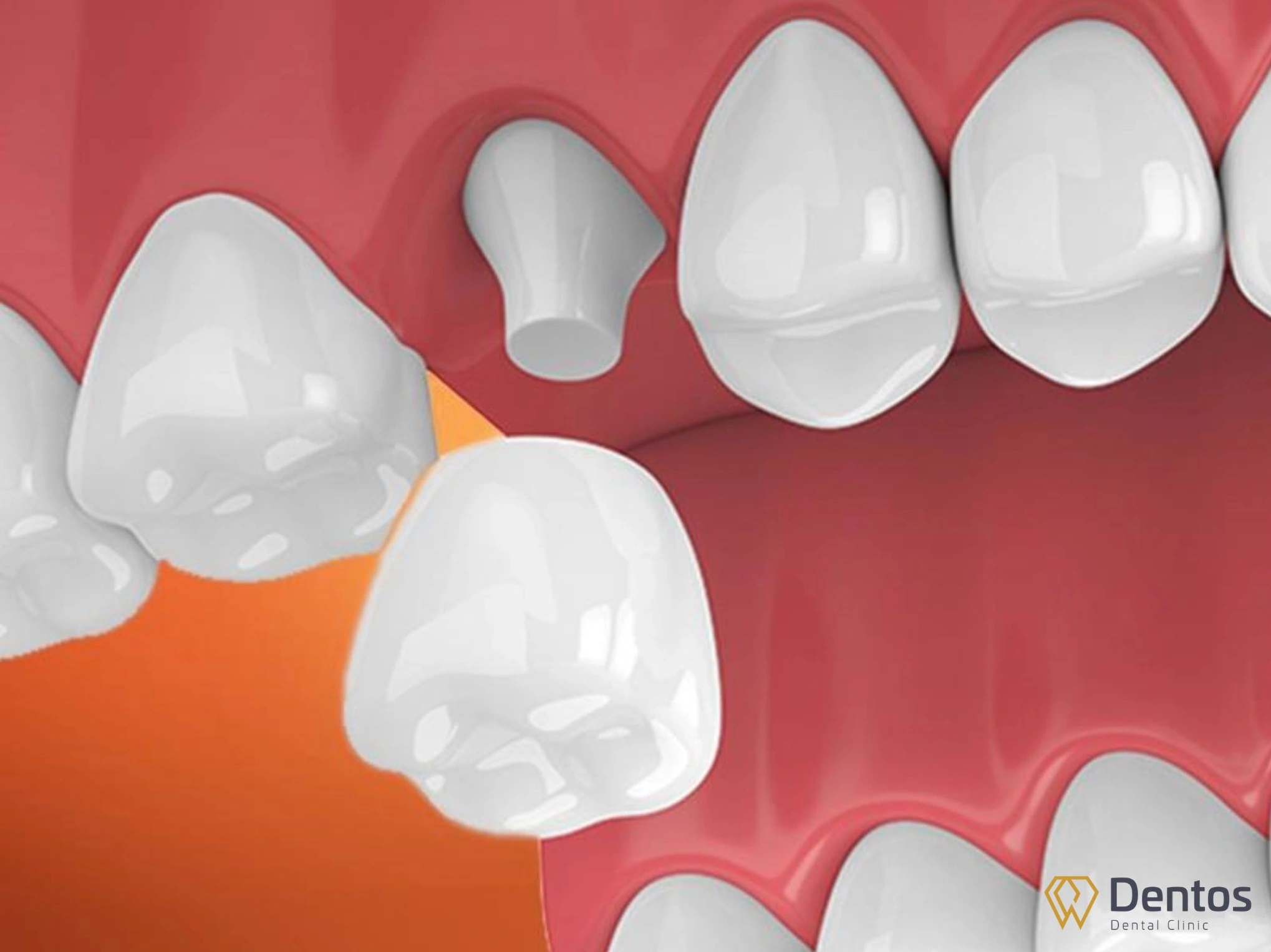 Làm răng sứ thẩm mỹ giúp cải thiện màu sắc, hình dạng, kích thước của răng