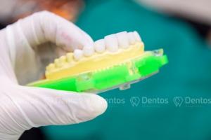 Bọc răng sứ chính là một phương pháp thẩm mỹ nha khoa hàng đầu hiện nay