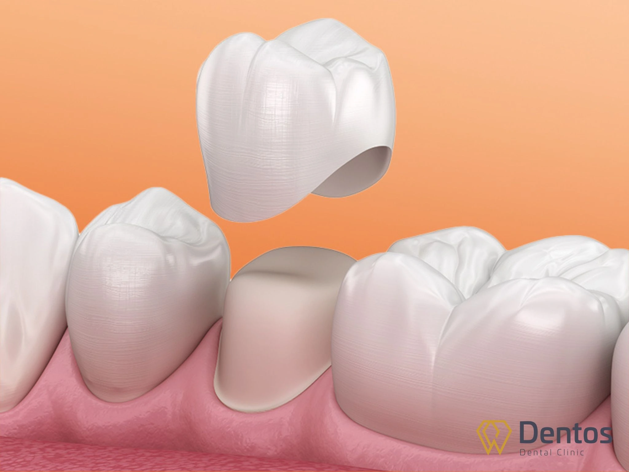 Cần điều trị dứt điểm tình trạng tụt lợi TRƯỚC KHI bọc răng sứ