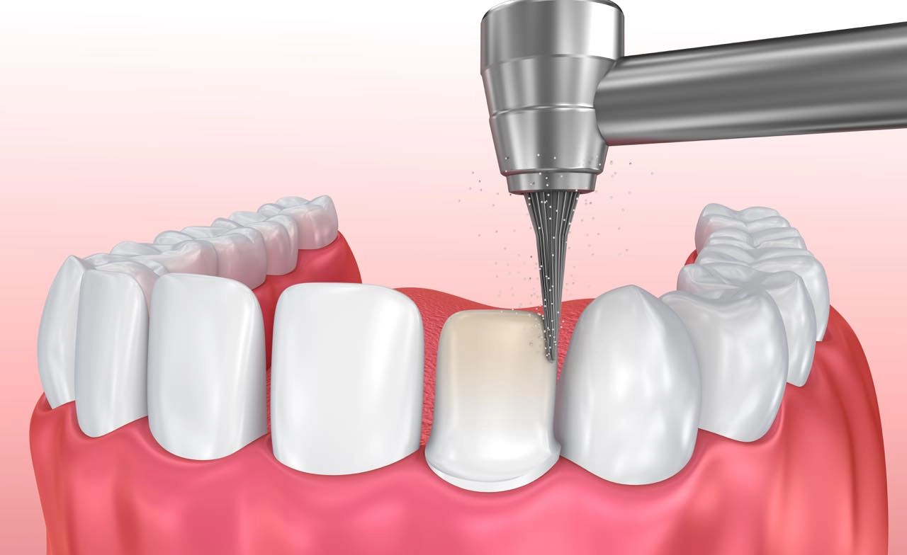 Bọc răng sứ là quy trình mài cùi răng sau đó chụp mão răng sứ lên trên (Nguồn: Sưu tầm)