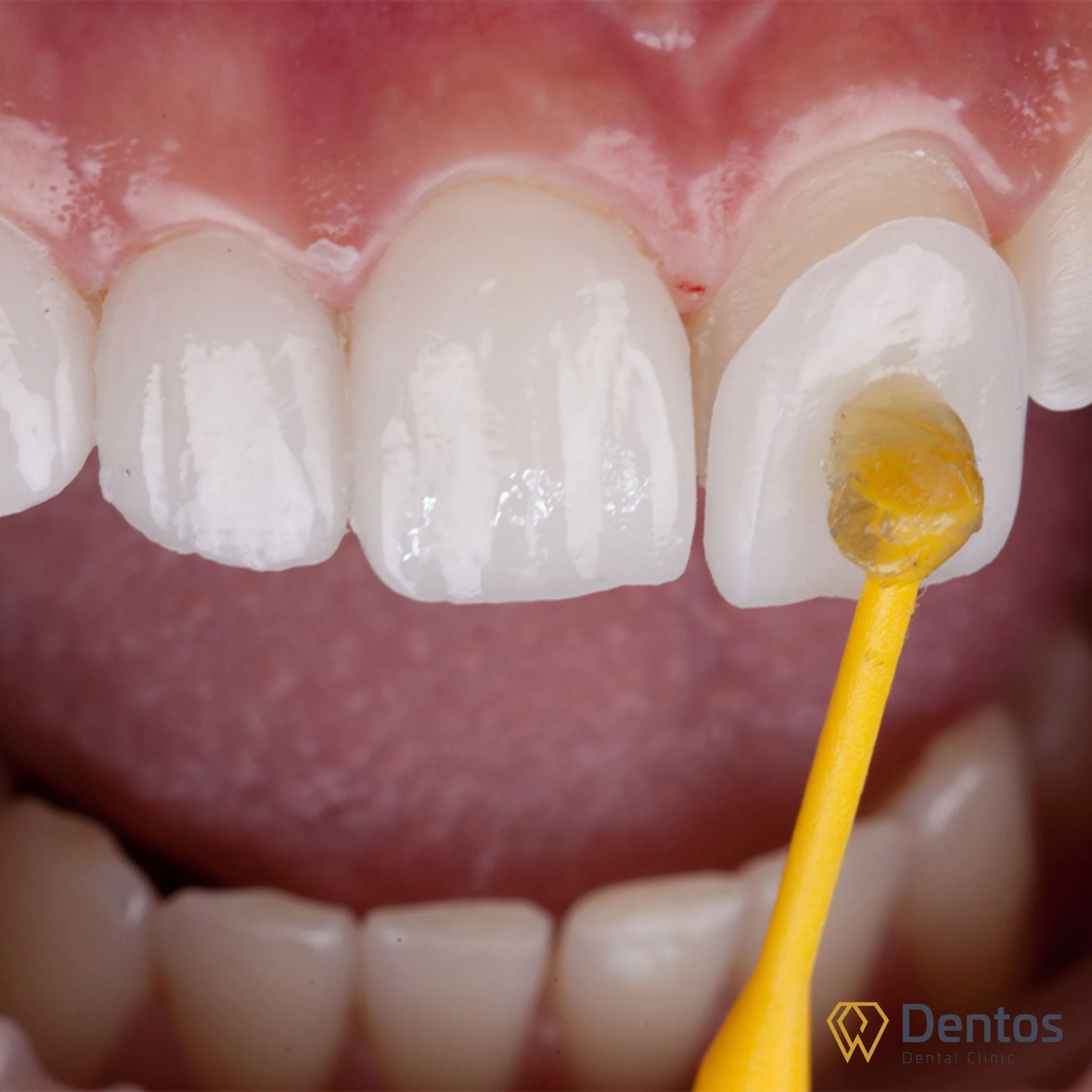 Mặt dán sứ Veneer là lớp sứ mỏng khoảng 0.2 mm - 0.5 mm dán vào bên ngoài bề mặt răng