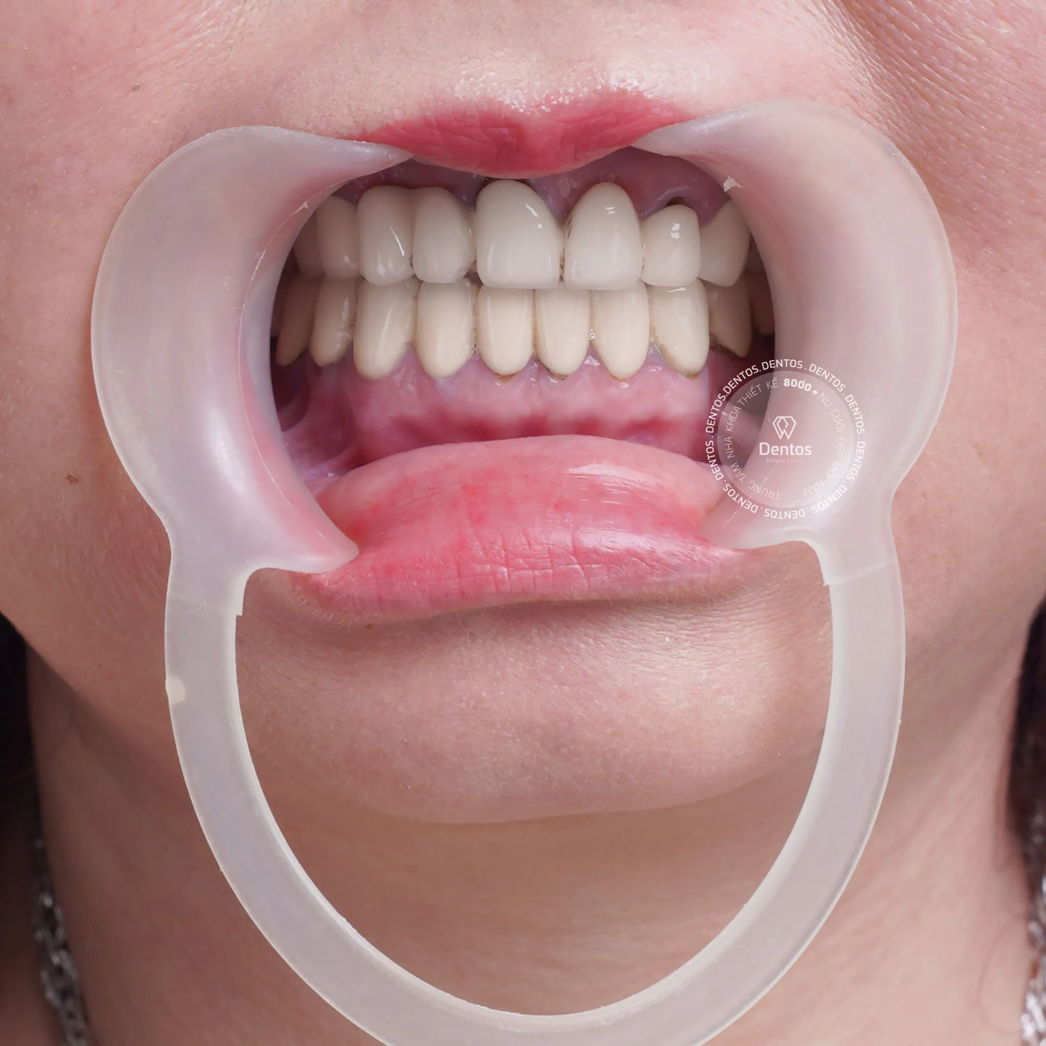 Răng sứ kim loại gây ra tình trạng đen viền chân răng rất mất thẩm mỹ