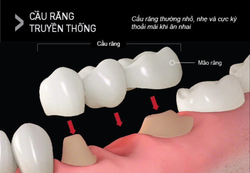 Cầu răng sứ là mài nhỏ hai răng thật khỏe mạnh hai bên khoảng trống để làm trụ đỡ