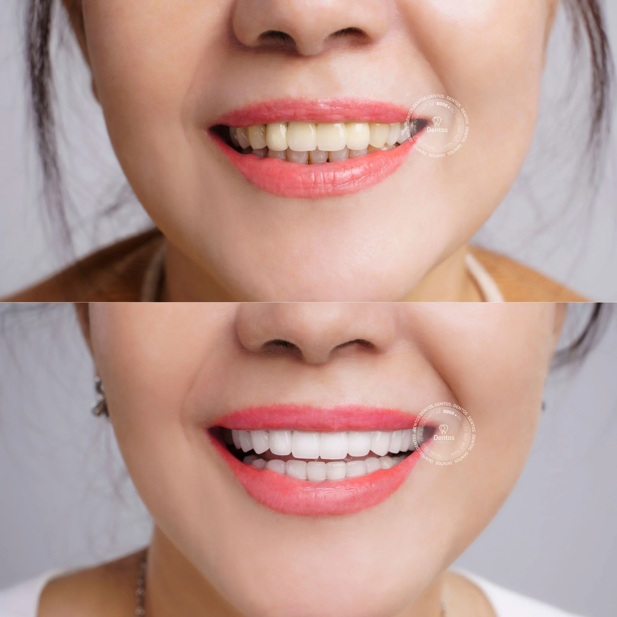 Cầu răng sứ có tính thẩm mỹ và độ bền cao