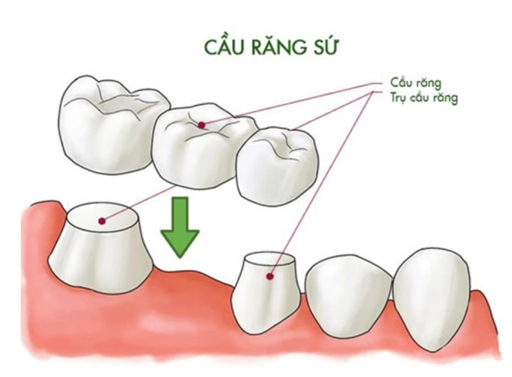 Làm cầu răng sứ là tạo một cầu nối gồm nhiều mão sứ được dính liền với nhau