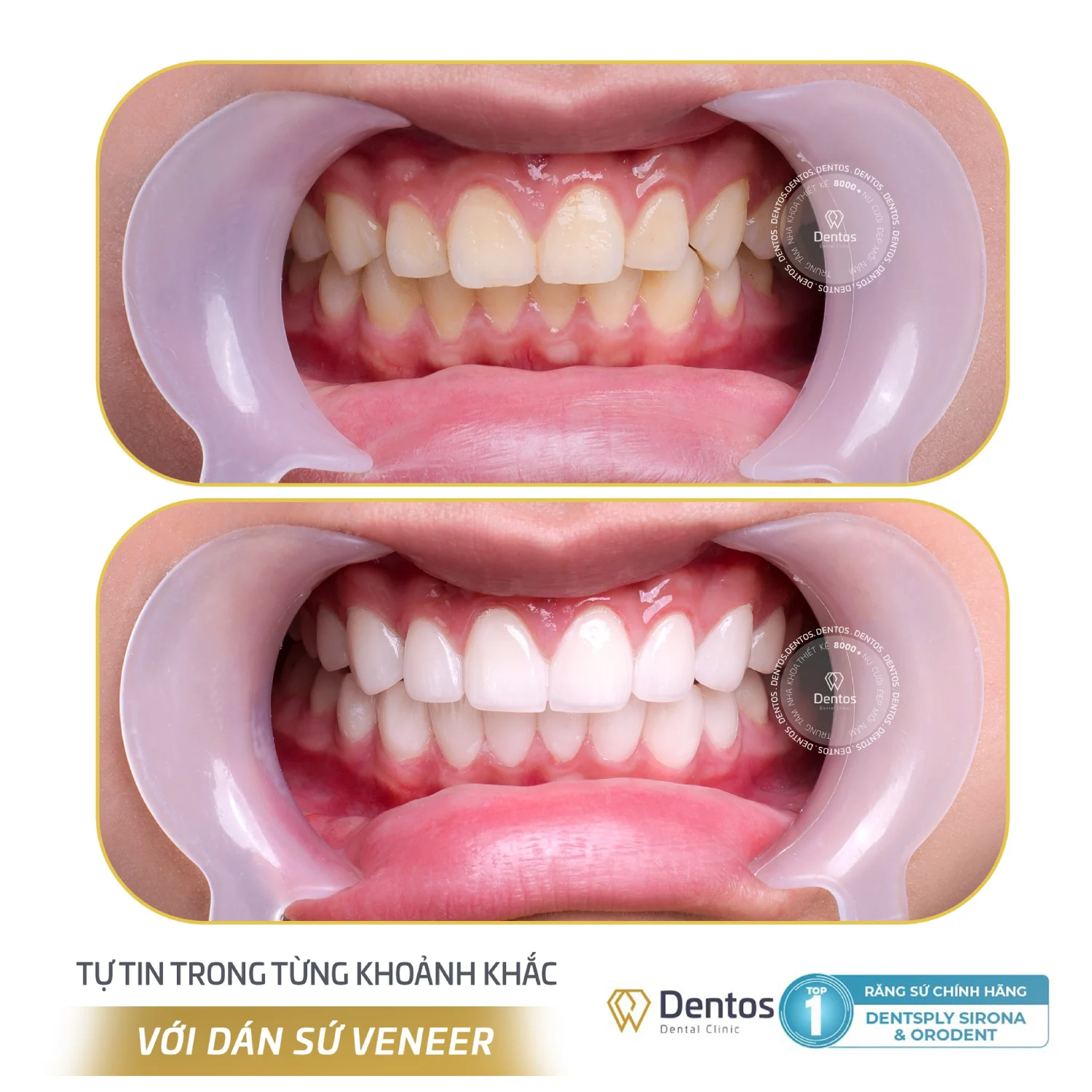 Nha khoa Dentos đặt triết lý bảo tồn răng thật lên hàng đầu trong mọi kế hoạch điều trị