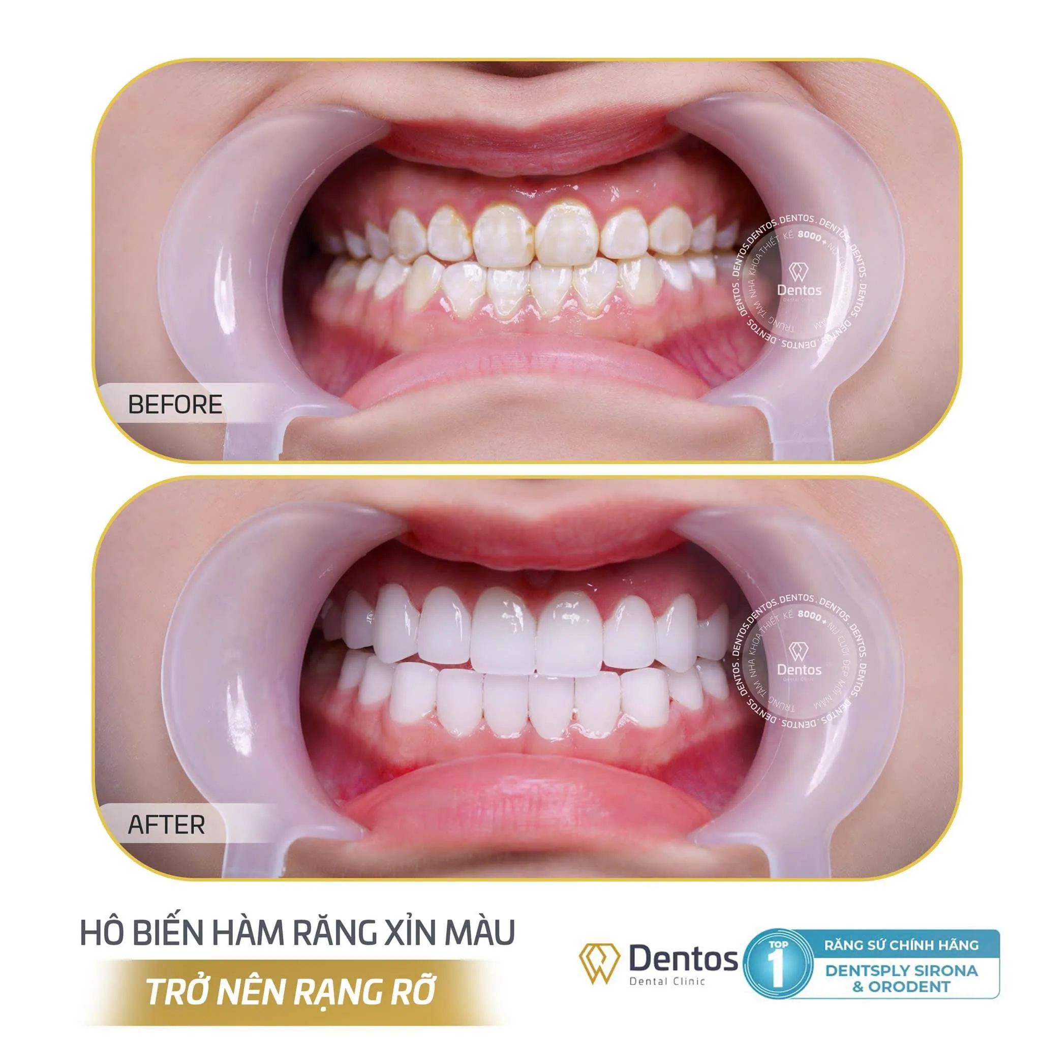 Dentos sử dụng mặt dán Veneer nhập khẩu chính hãng để đảm bảo chất lượng tốt nhất