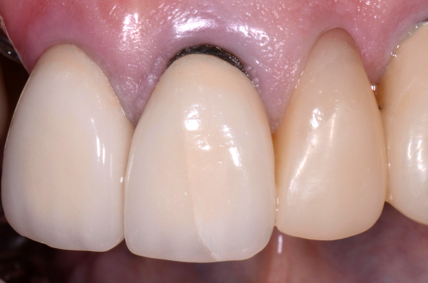 Bọc răng sứ kim loại gây đen viền nướu sau một thời gian sử dụng (Nguồn: St)