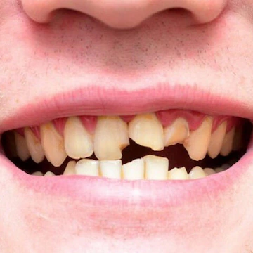 Răng bị chấn thương nặng nên bọc sứ 