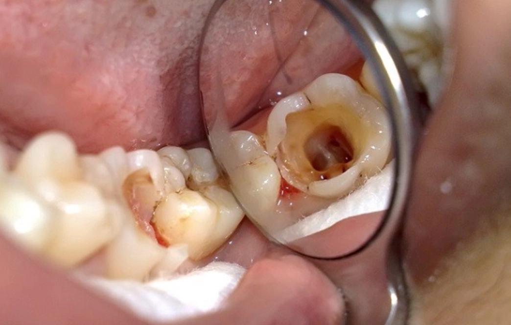 Kỹ thuật gây tê và công nghệ nội nha tiên tiến giúp điều trị chính xác, hiệu quả, không đau