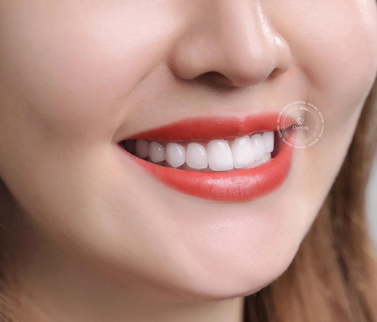 Răng toàn sứ Zirconia không gây đen viền nướu, đảm bảo tính thẩm mỹ tối ưu