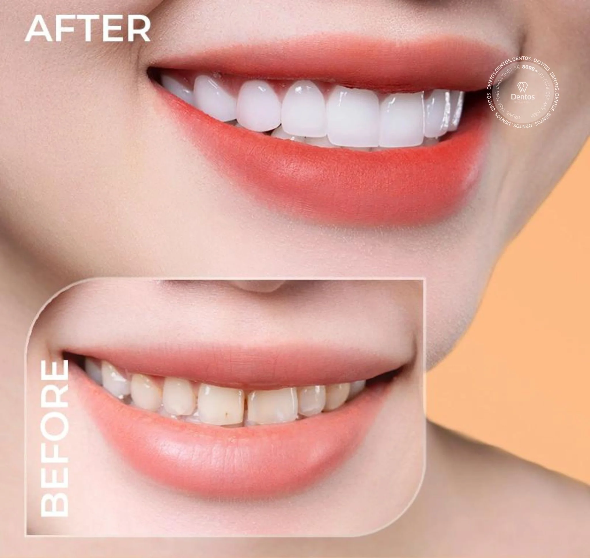 Răng sứ Zirconia có tốt hay không? - Cải thiện tình trạng răng bị nhiễm màu nặng