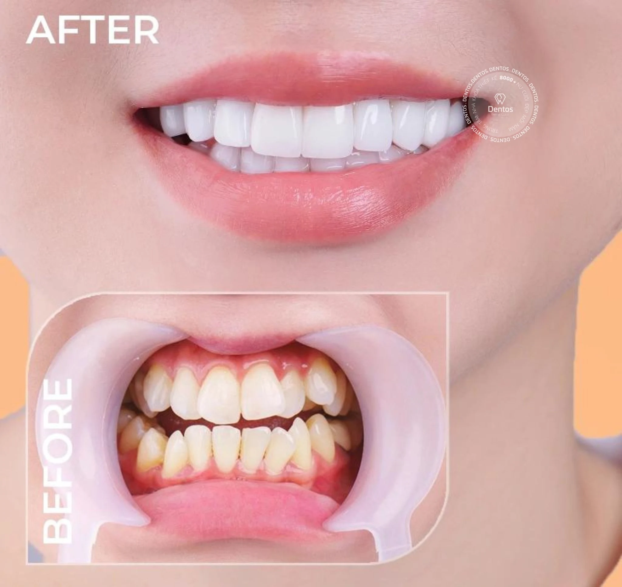 Răng sứ HT Smile giúp cải thiện tình trạng màu răng không thẩm mỹ