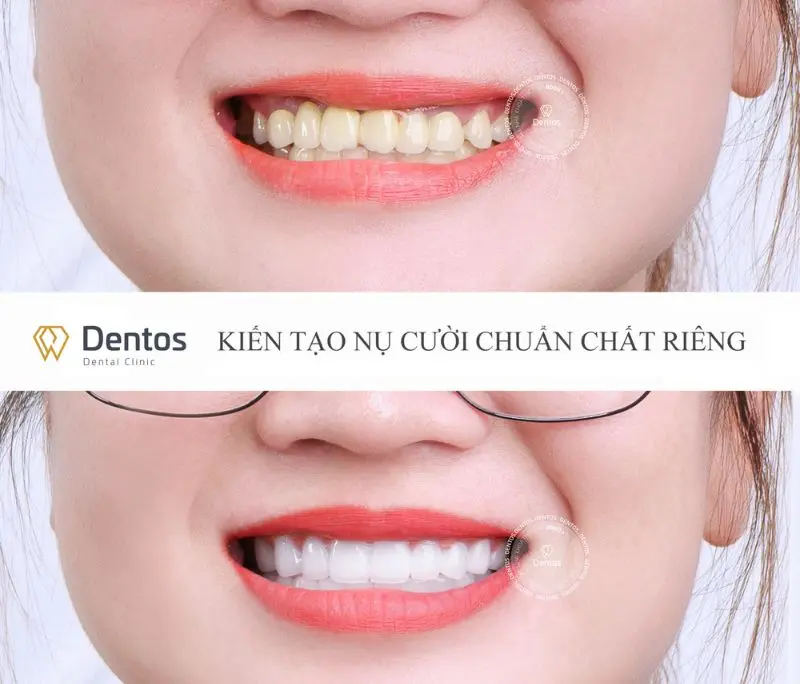 Bọc răng sứ Orodent cho răng bị nhiễm màu