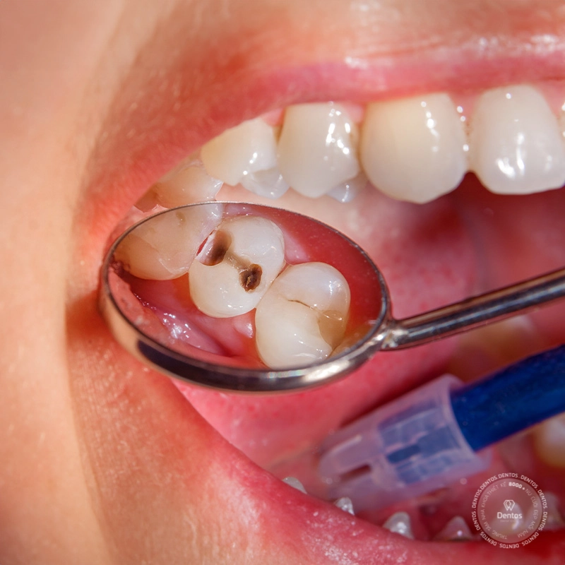 Sâu răng là nguyên nhân hàng đầu gây ra viêm tủy răng (Nguồn: St)