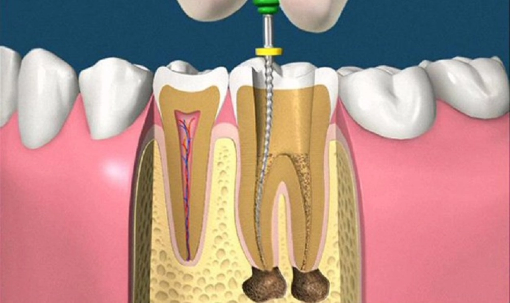 Điều trị tuỷ răng là quá trình loại bỏ các mô tuỷ bị tổn thương hoặc nhiễm trùng từ bên trong