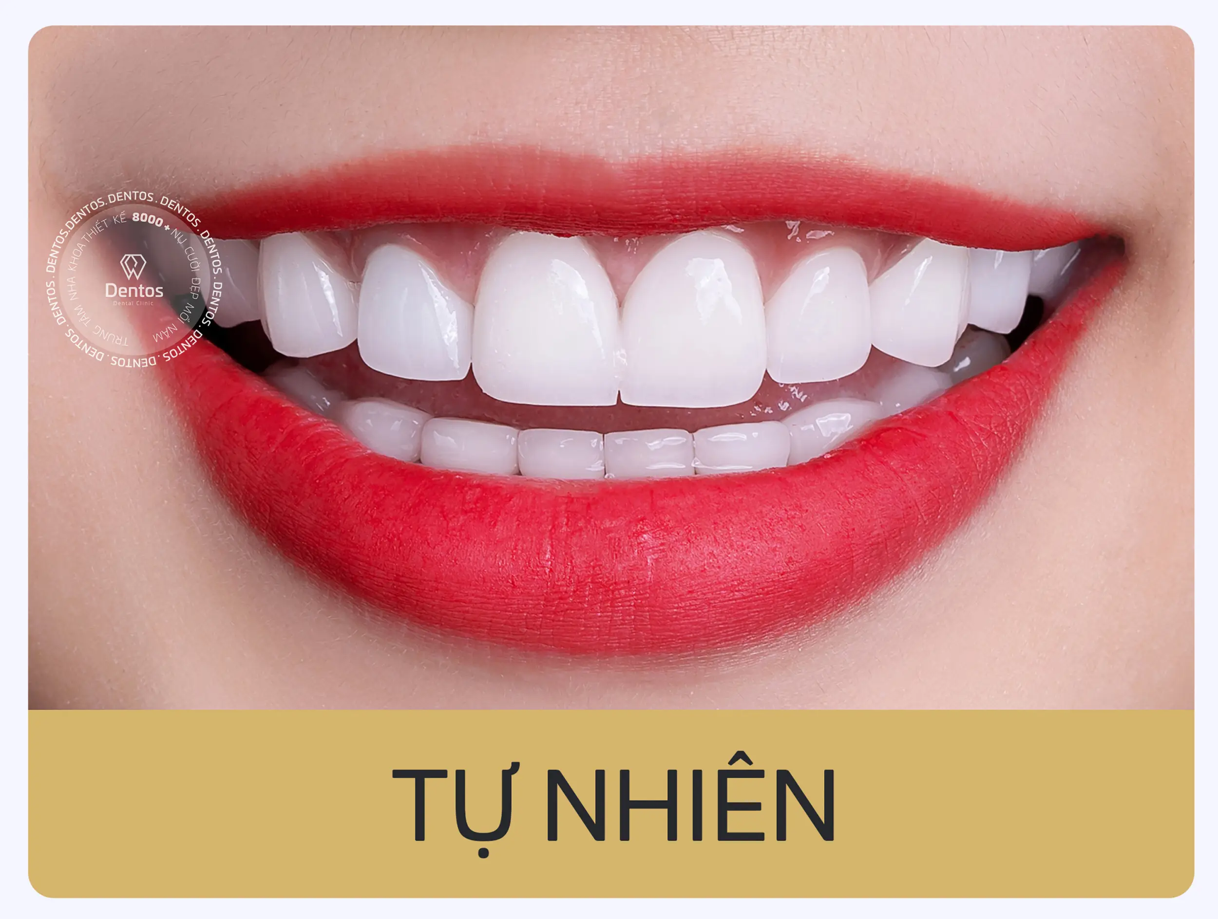 Mẫu răng sứ đẹp dáng tự nhiên