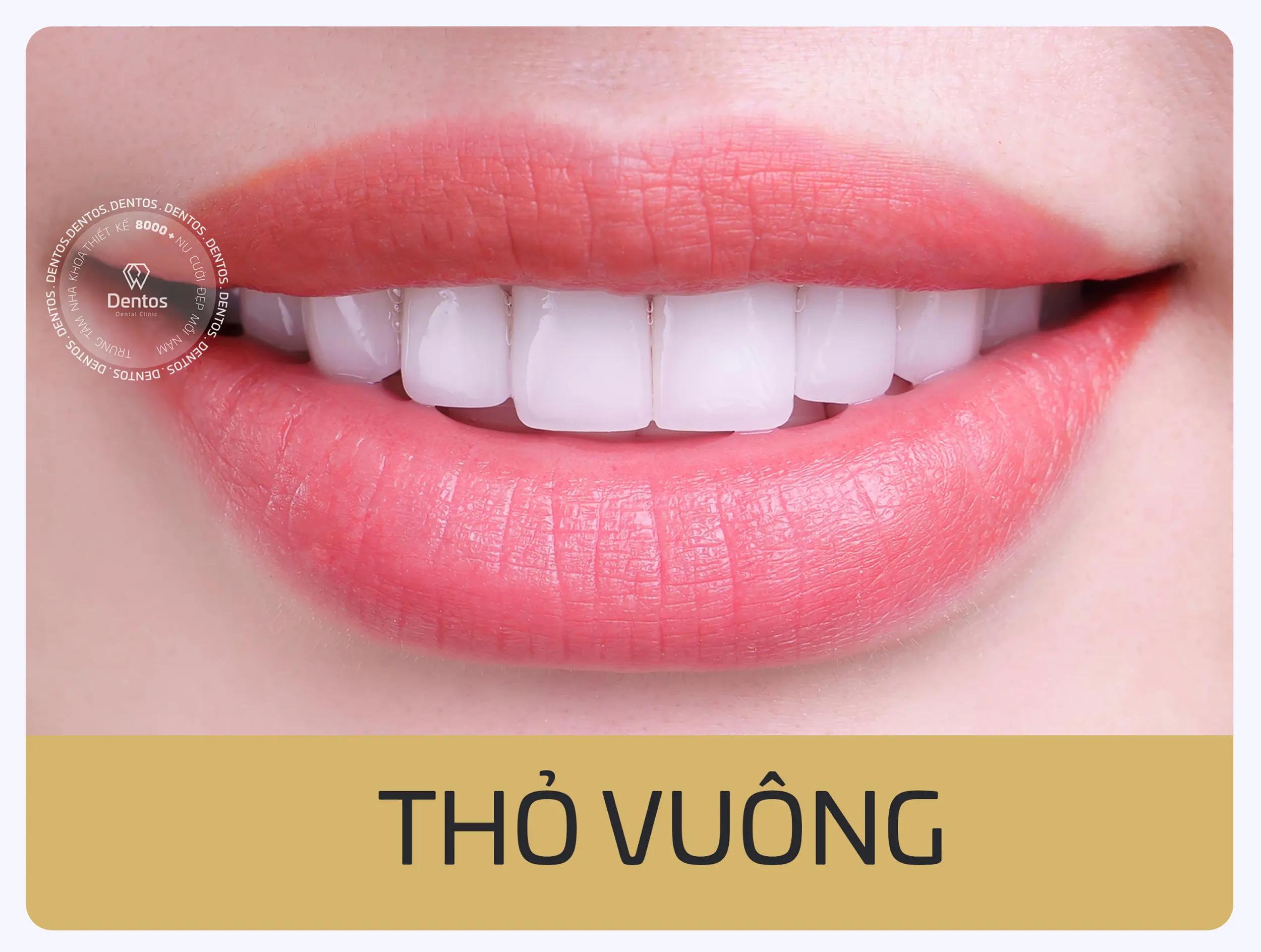 Mẫu răng sứ dáng Thỏ Vuông
