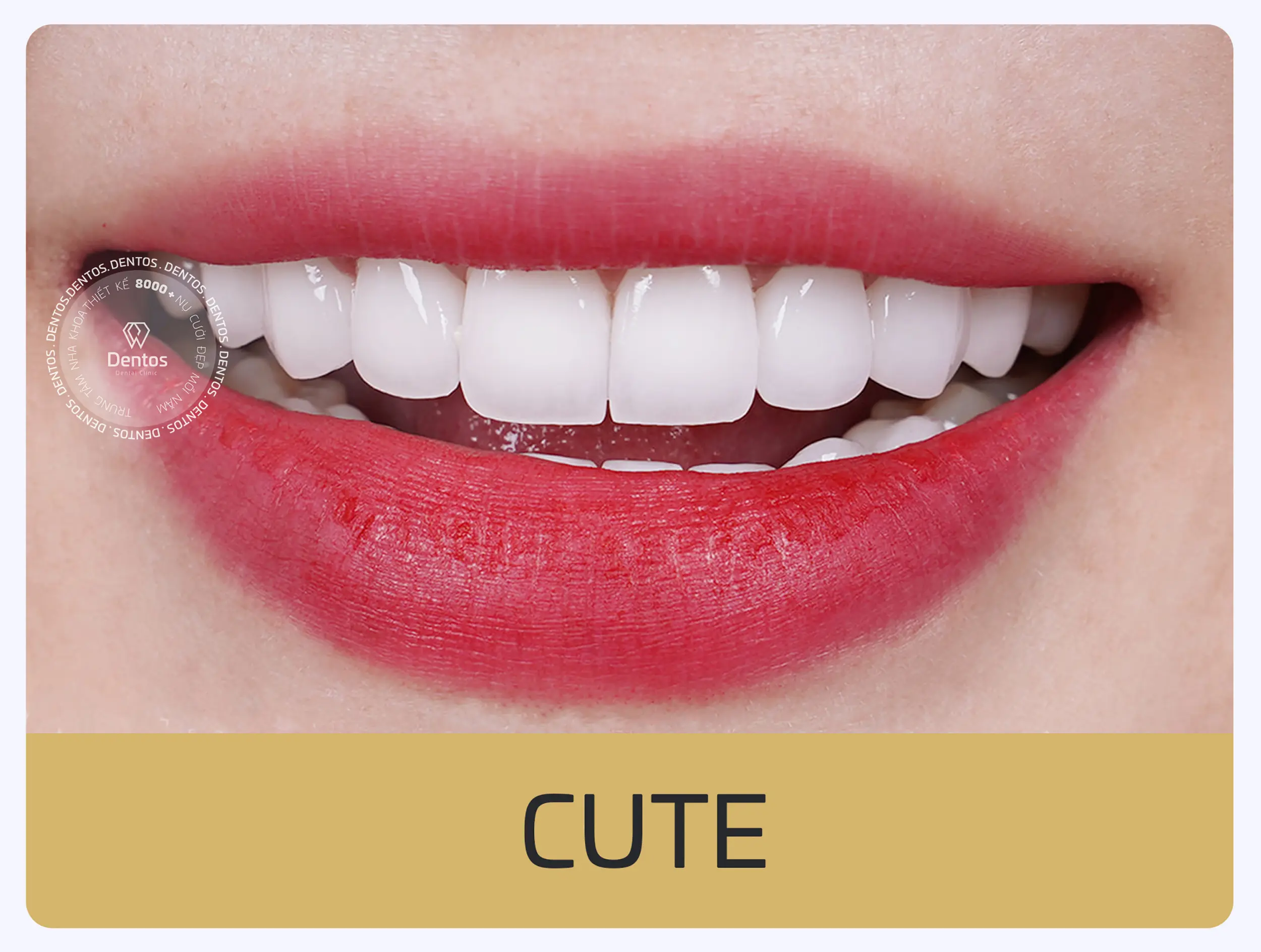 Bọc răng sứ phong thủy Dentos - Dáng răng sứ cute