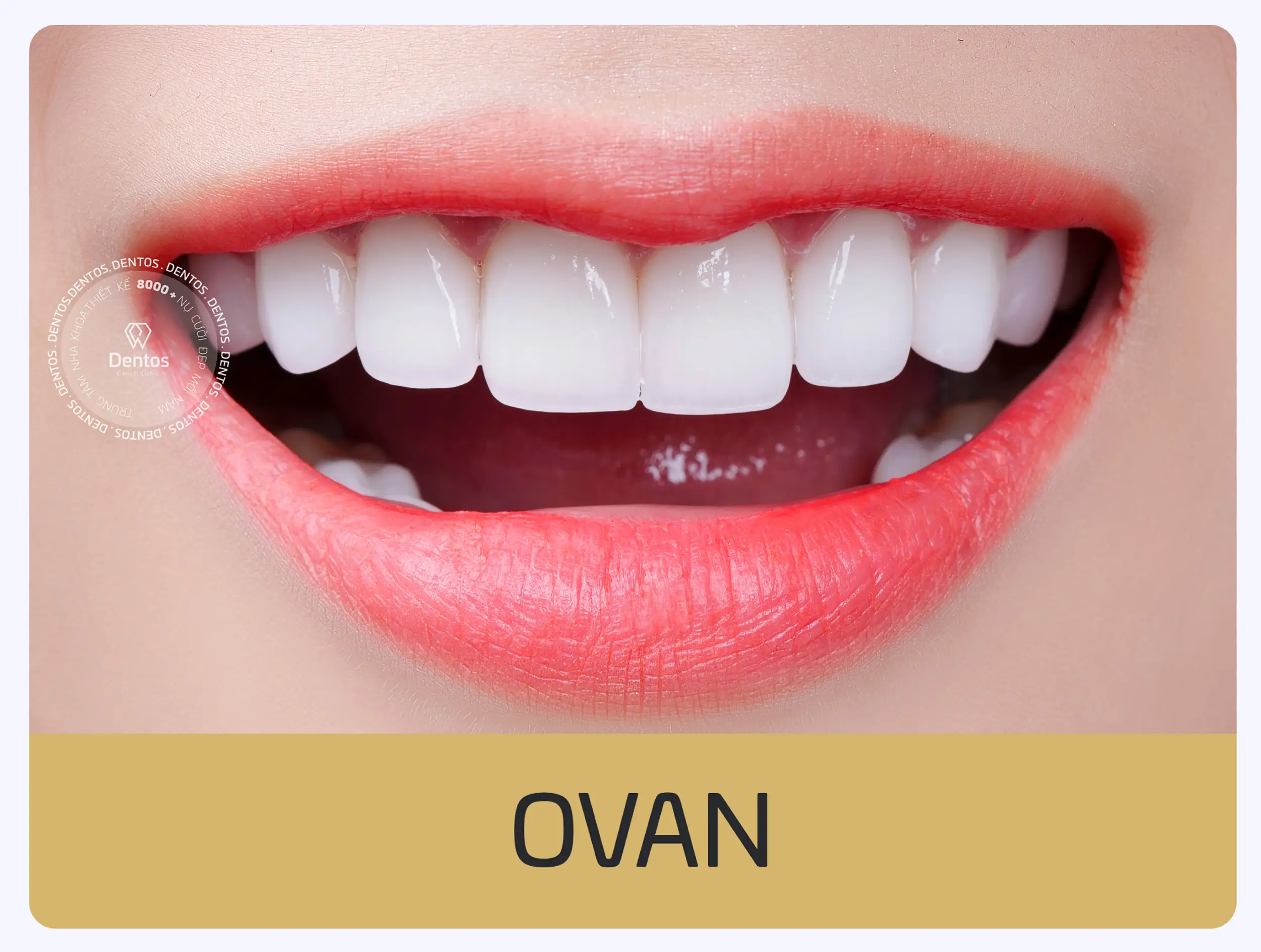 Mẫu răng sứ dáng Ovan