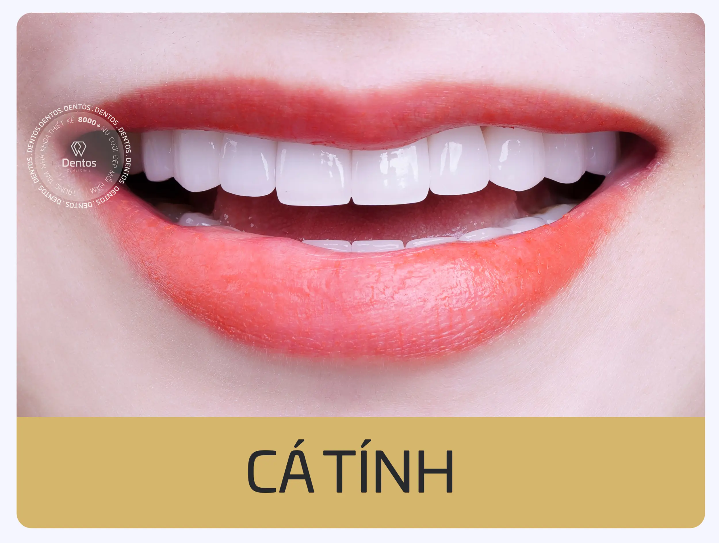 Mẫu răng sứ dáng Cá Tính